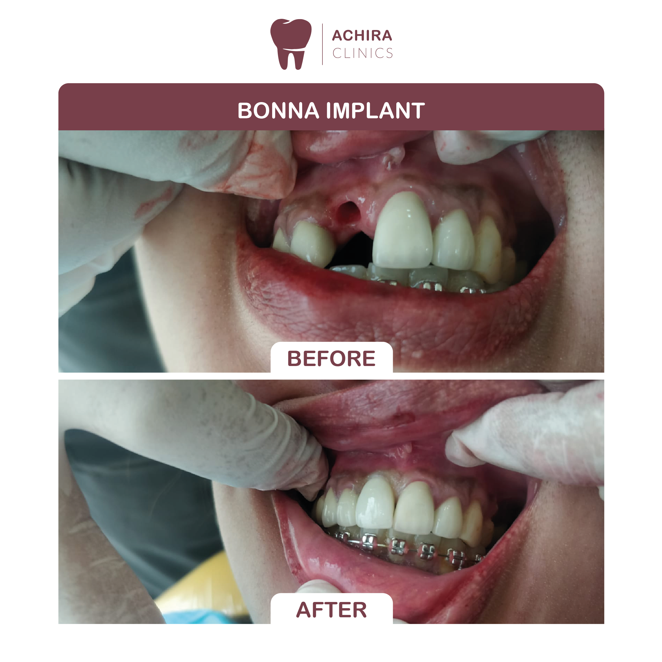 Bonna Implant 01